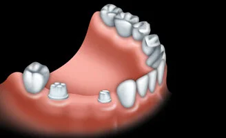 dental-bridge-1.jpg