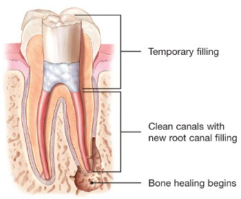 root-canal-retreatment-3.png
