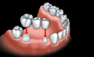 dental-bridge-2.jpg