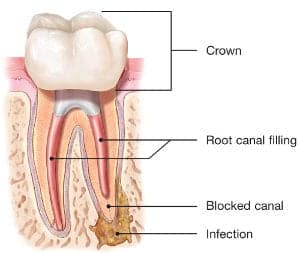 Images credit: American Academy of Endodontics