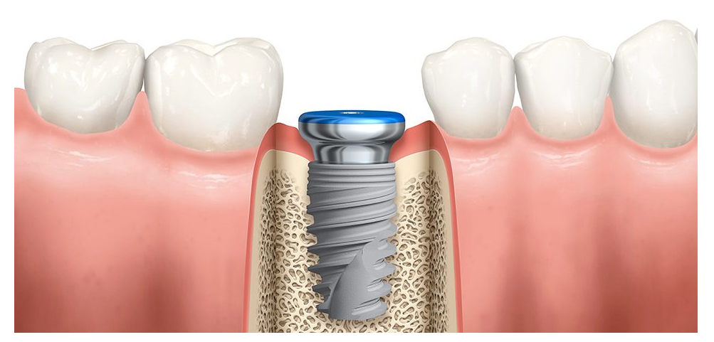 Image credit: Nobel Biocare