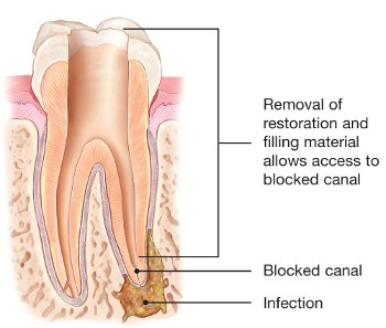 root-canal-retreatment-2.png
